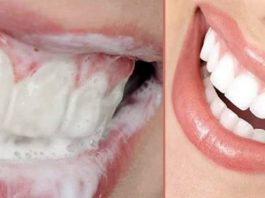 Рецепт, который поможет за несколько дней убрать зубные камни, а также сделать зубы блестяще белыми